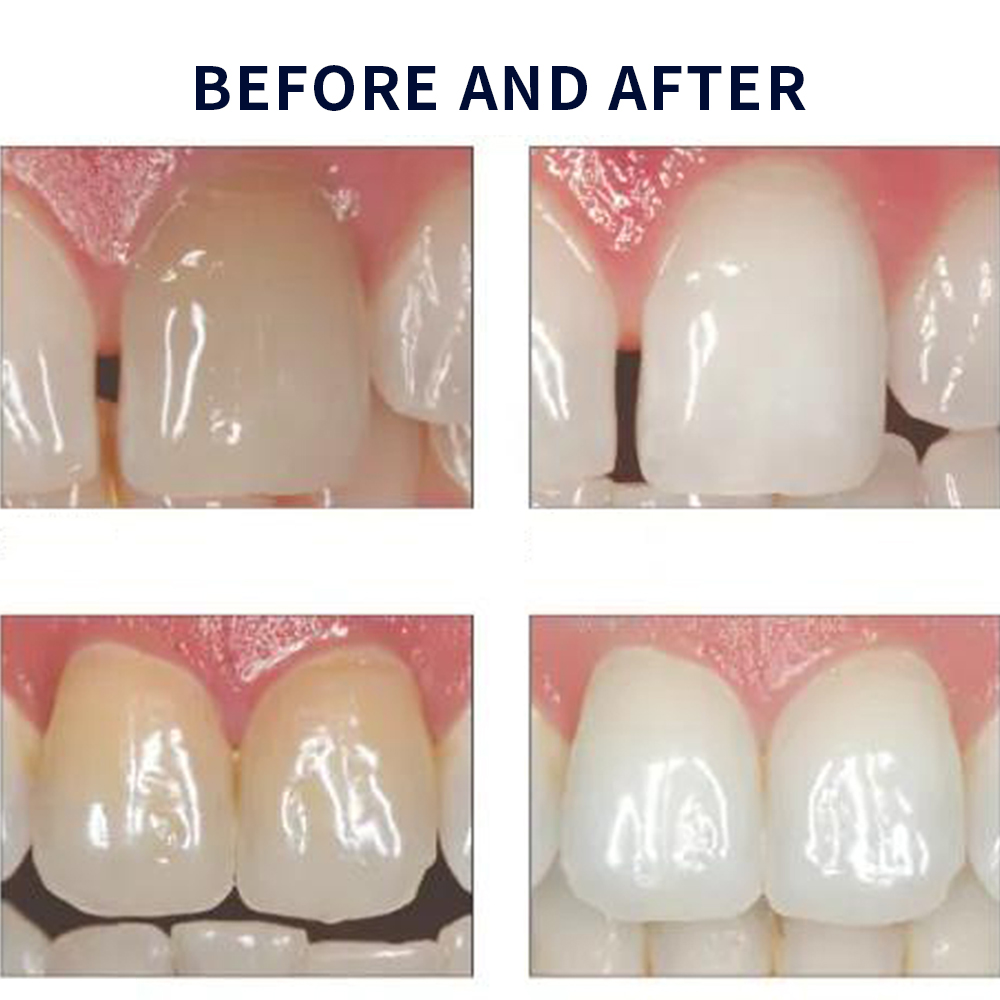 Opalescence Whitening 20% PF 2 - Teeth Whitening Near Me recensione e prezzo