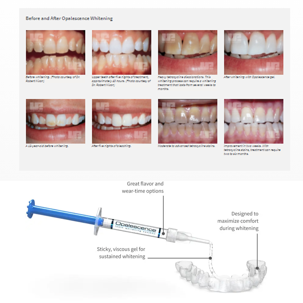 Opalescence Whitening 20% PF 2 - Teeth Whitening Near Me recensione e prezzo