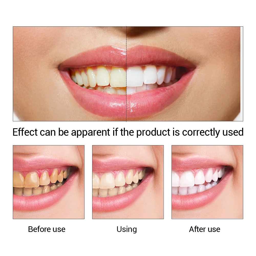 FTEENPLY Teeth Whitening Essen - Teeth Whitening Serum recensione e prezzo