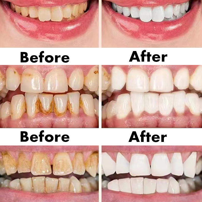 Teeth Whitening Pen Dental Ess - Teeth Whitening Serum recensione e prezzo