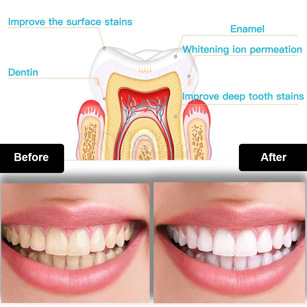 Dental Teeth Whitening Kit Min - Teeth Whitening Near Me recensione e prezzo