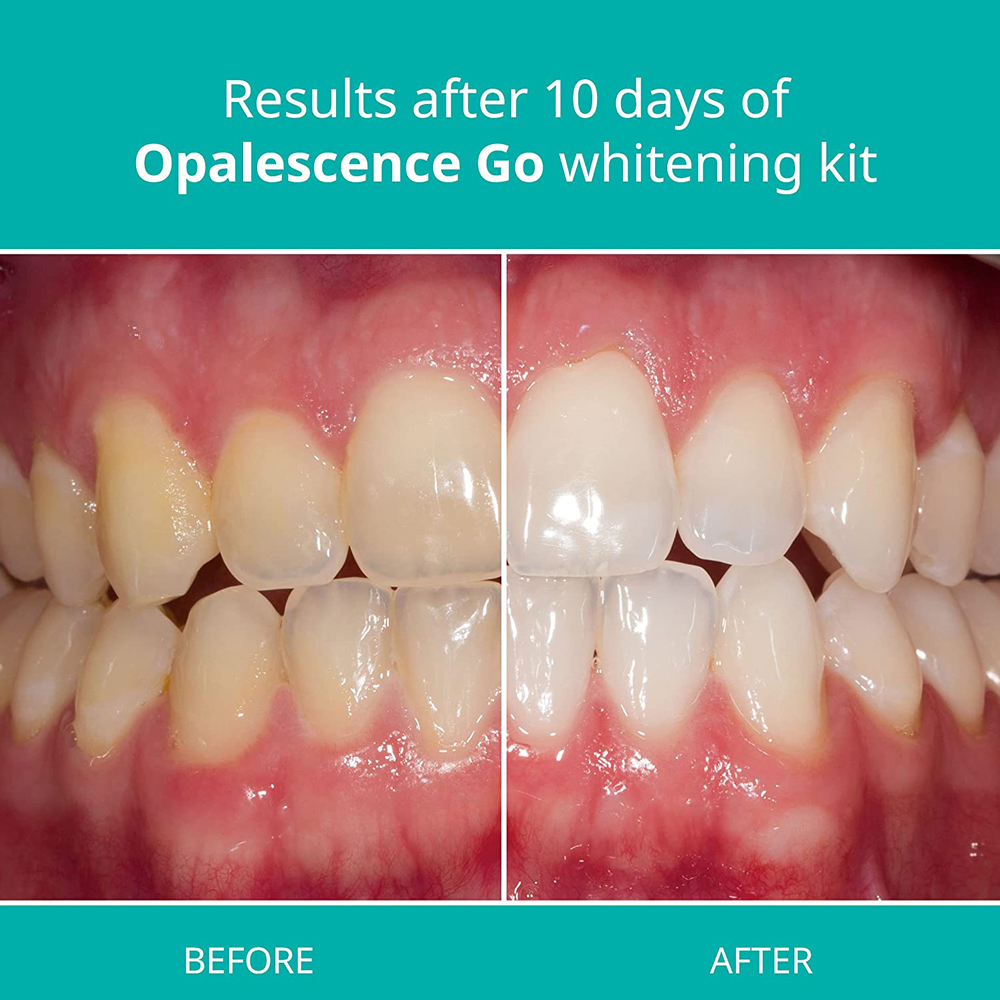 Opalescence Go Teeth Whitening - Teeth Whitening Home Kit recensione e prezzo